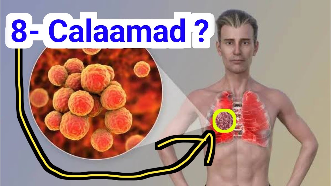 8- Calaamad Tiibishada LAGU qaldo Burukiitada iyo oof-wareenka iyo sida loo kala Saaro #dr_timajilac