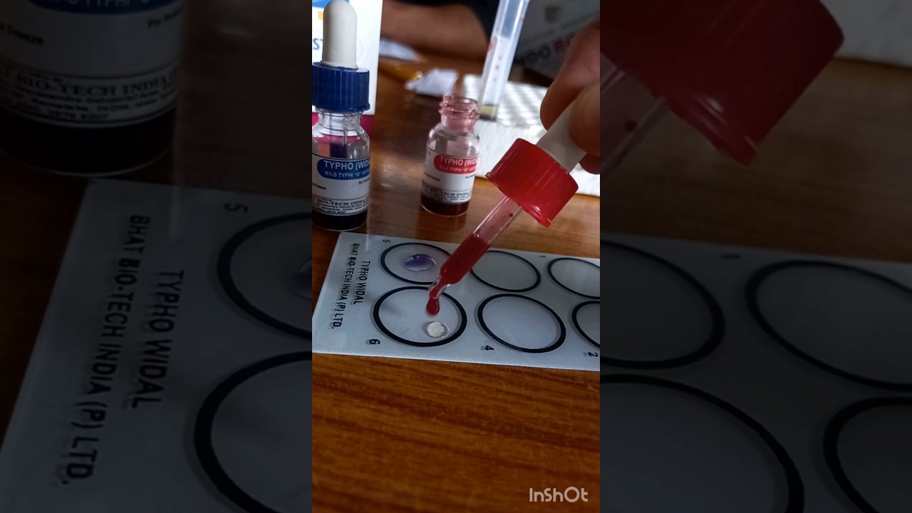 WIDAL TEST PROCEDURE FOR TYPHOID