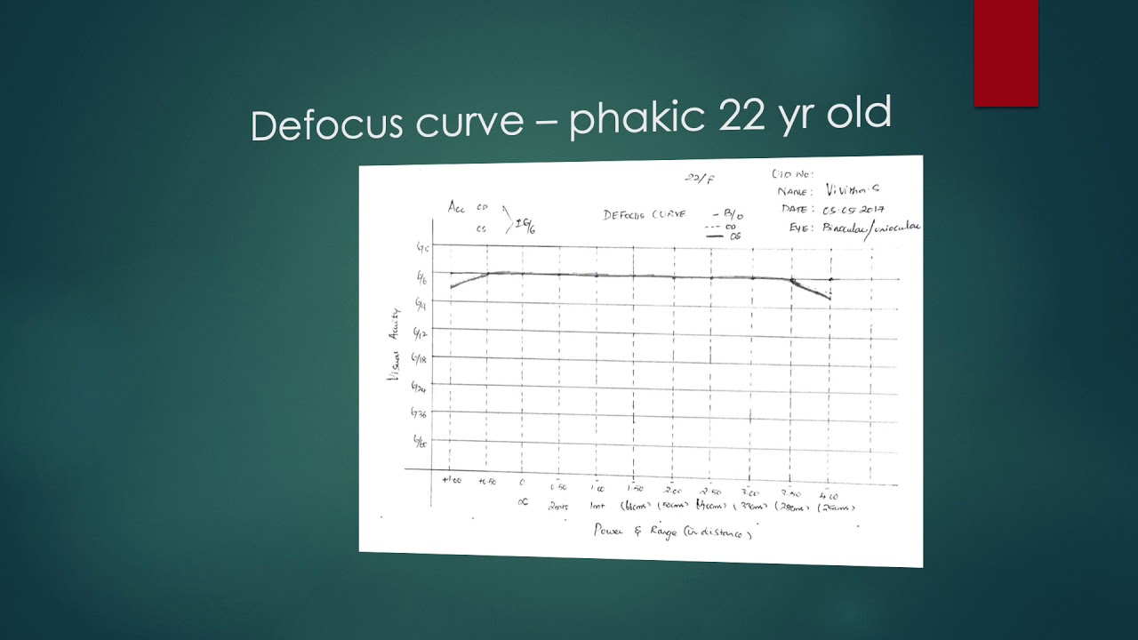 Decoding the 'Defocus Curve' to analyse visual performance of Presbyopia correcting IOLs