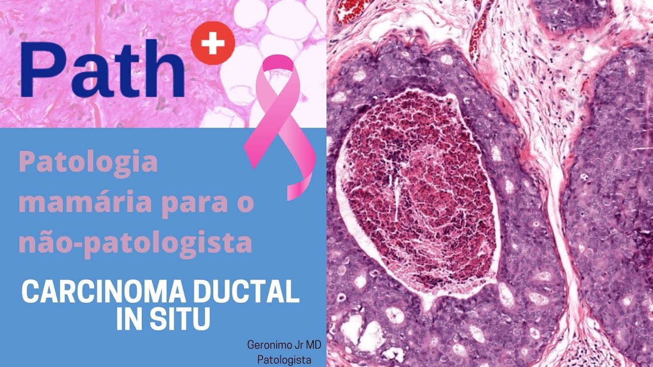 Carcinoma Ductal in situ para o não patologista - Uma atualização