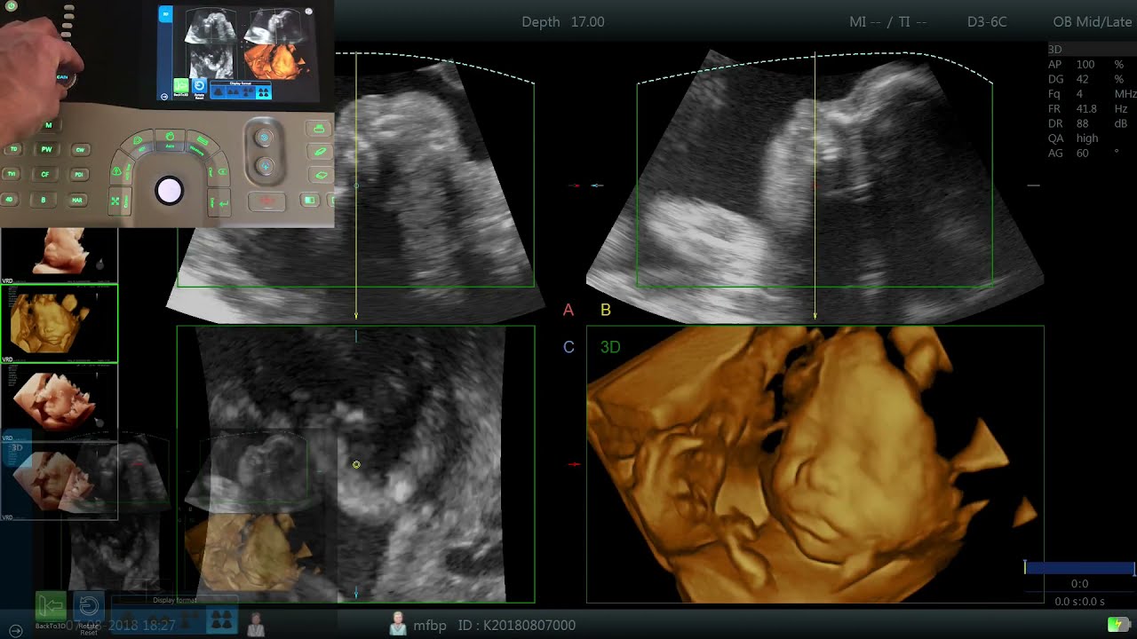 Editing 3D Images on Vinno 5 Portable Ultrasound Machine