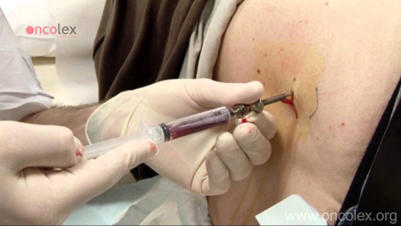 Bone marrow aspiration and biopsy from the iliac crest &bull; Oncolex