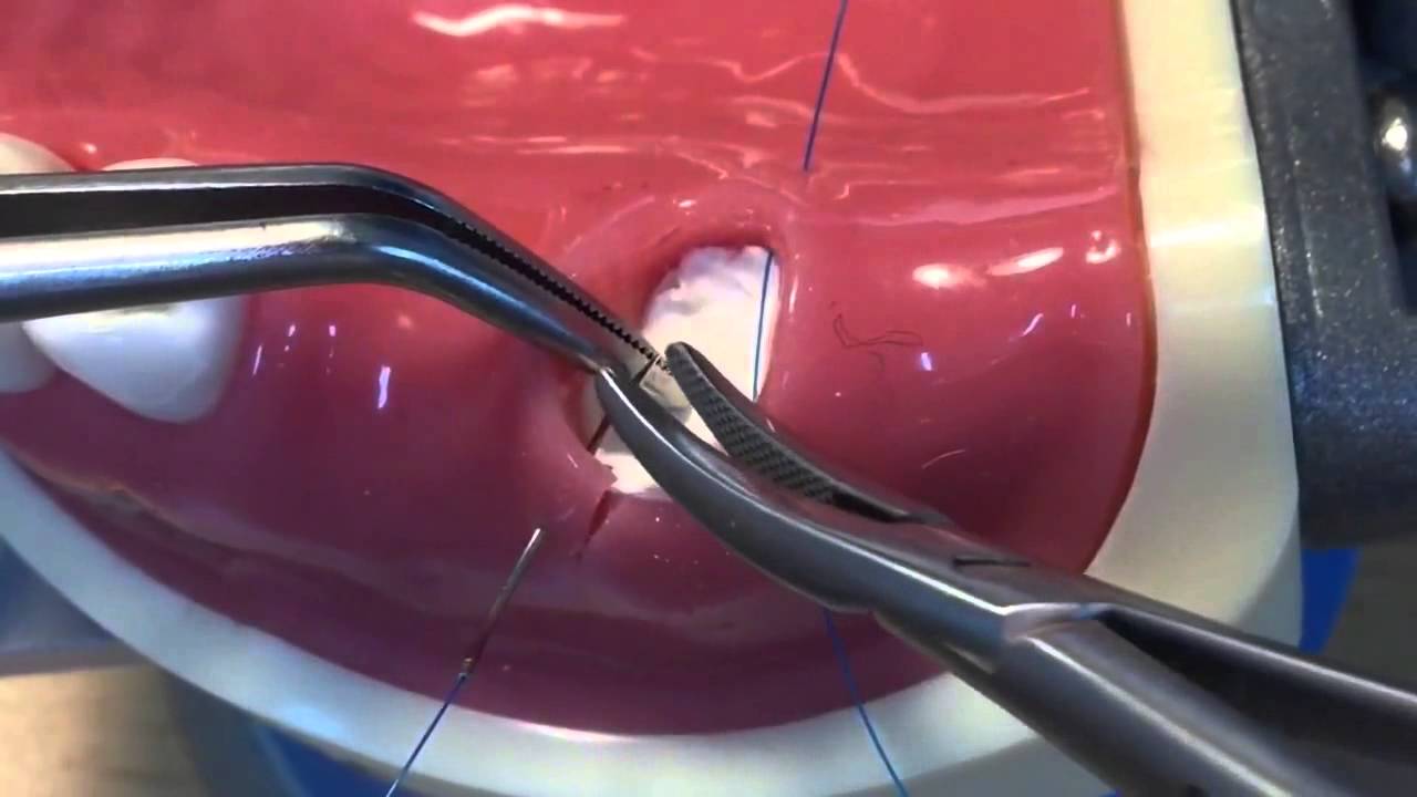 Ridge preservation+Double Layered Open Membrane Technique DL OMT + Hidden X