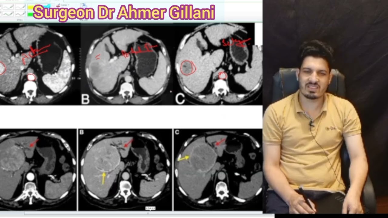 Triphasic CT SCAN typical of Hepatocellular Carcinoma Explained Simply/ FCPS / CPSP/MD/