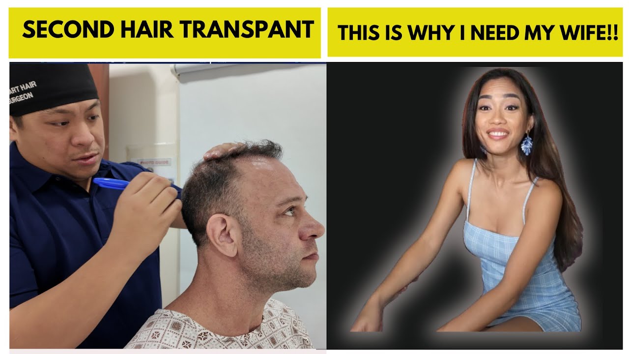 Second Hair Transplant Philippines? | Why I Did It Again?