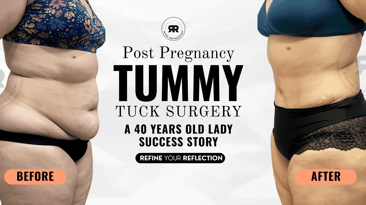 Post Pregnancy Tummy Tuck Transformation | 40-Year-Old Mom Success Story