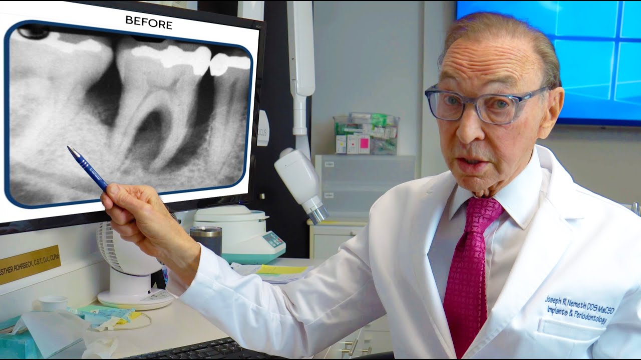 Bone Growth Can SAVE Teeth Damaged by Gum Disease! Before & After Photos