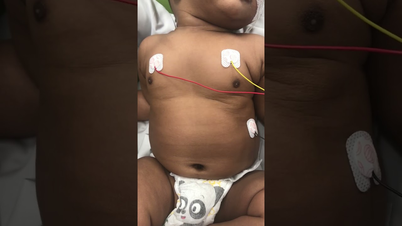 An infant's compliant chest wall in respiratory distress
