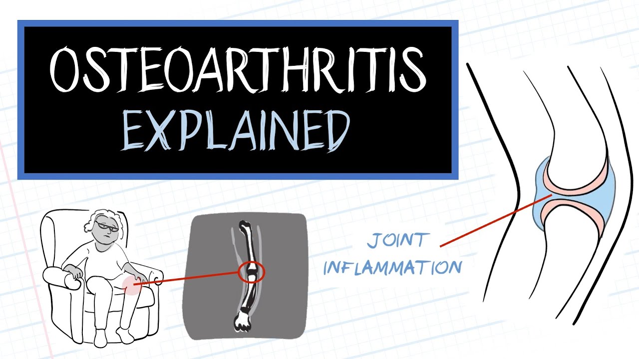 Что такое остеоартрит? (HealthSketch)