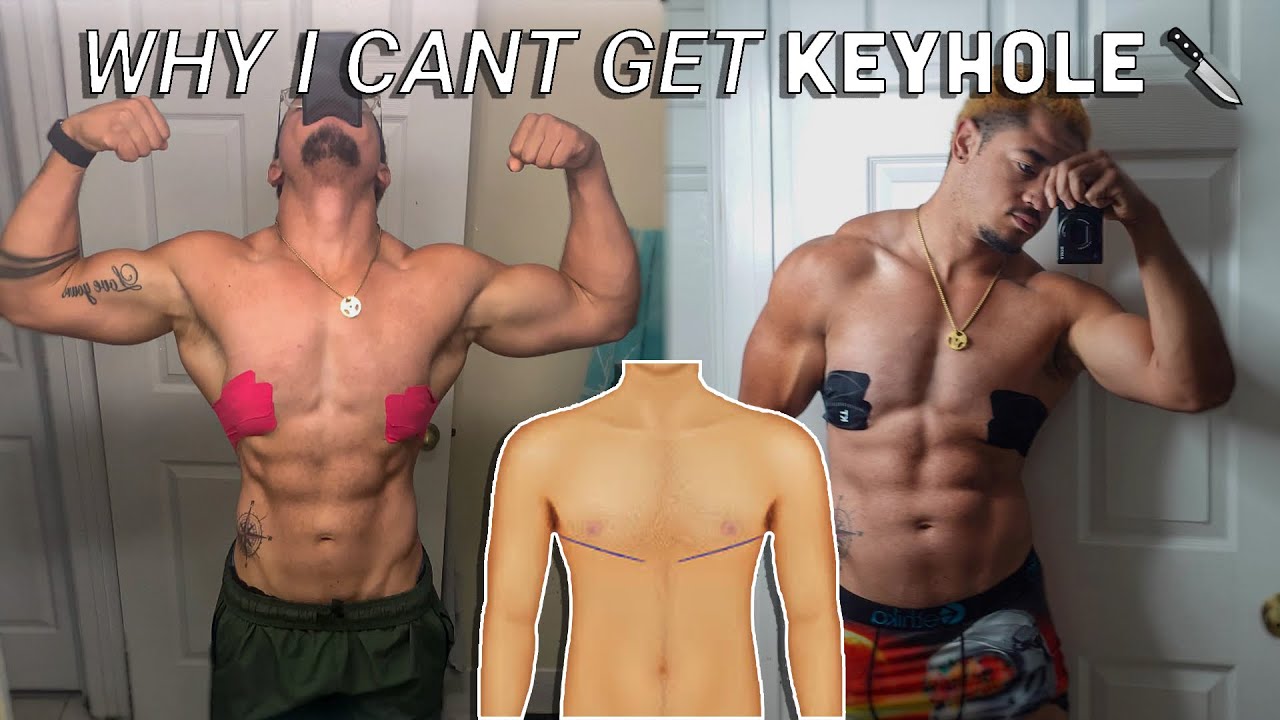 Why I can’t get Keyhole | FTM top surgery