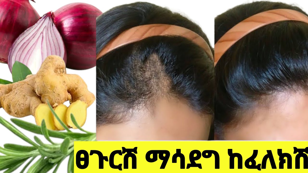 ተአምረኛ የዝጅብል እና የሽንኩርት የፀጉር ቅባት ለእድገት ብዛት ለሚነቃቀል |Best Oil For Faster Hair growth