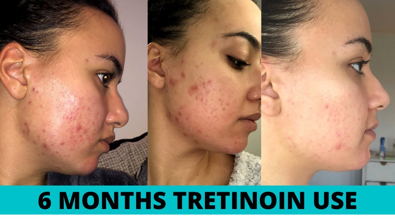 RETIN-A BEFORE AND AFTER 6 MONTHS | My Retin-a journey
