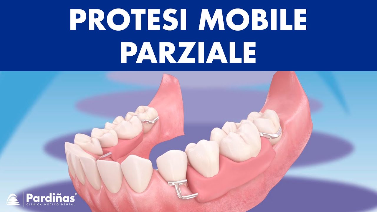 Protesi mobile parziale ©