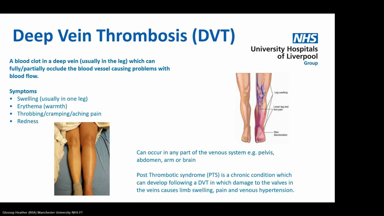 Thrombosis and Pregnancy   RN Francesca Murphy