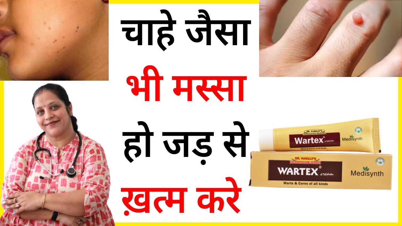 मस्से का इलाज |  | Warts ka ilaj | Masse ka ilaj | Wartex cream | Warts homeopathic medicine