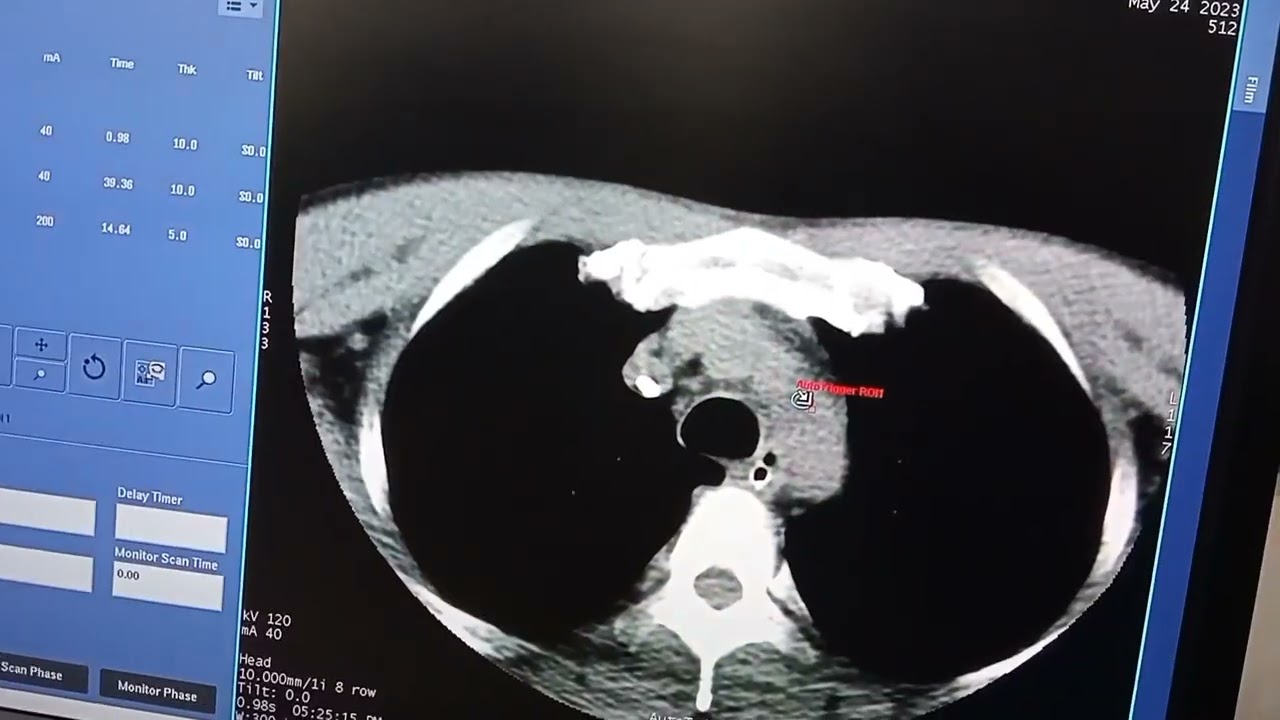 How to do ct brain neck angio