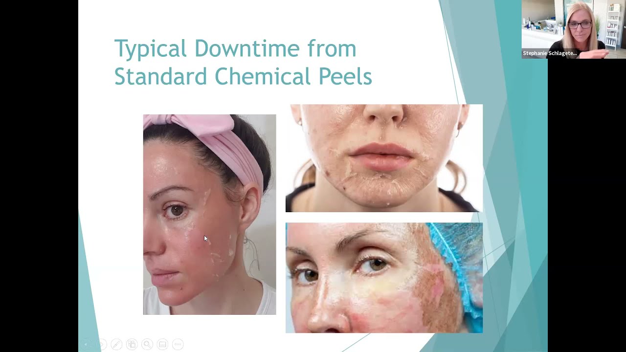 Introducing WiQo PRX T-33 at Radiance Medspa