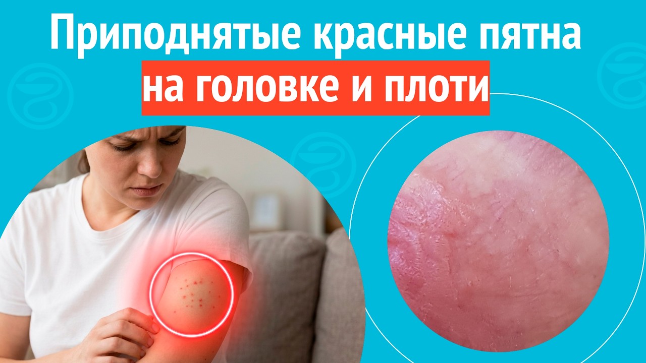 😡 Приподнятые красные пятна на головке и плоти. Клинический случай № 1725