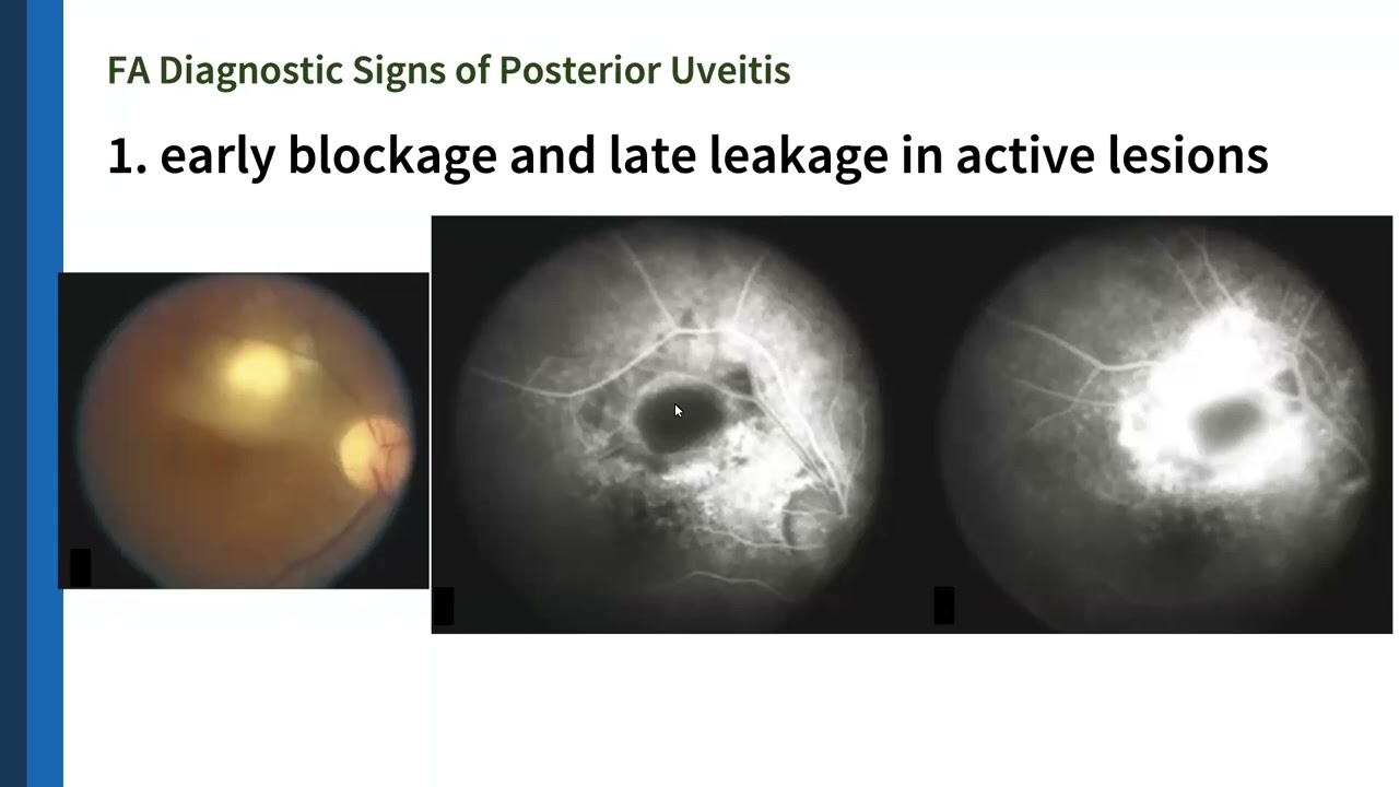 Fluorescein angiography (FA)