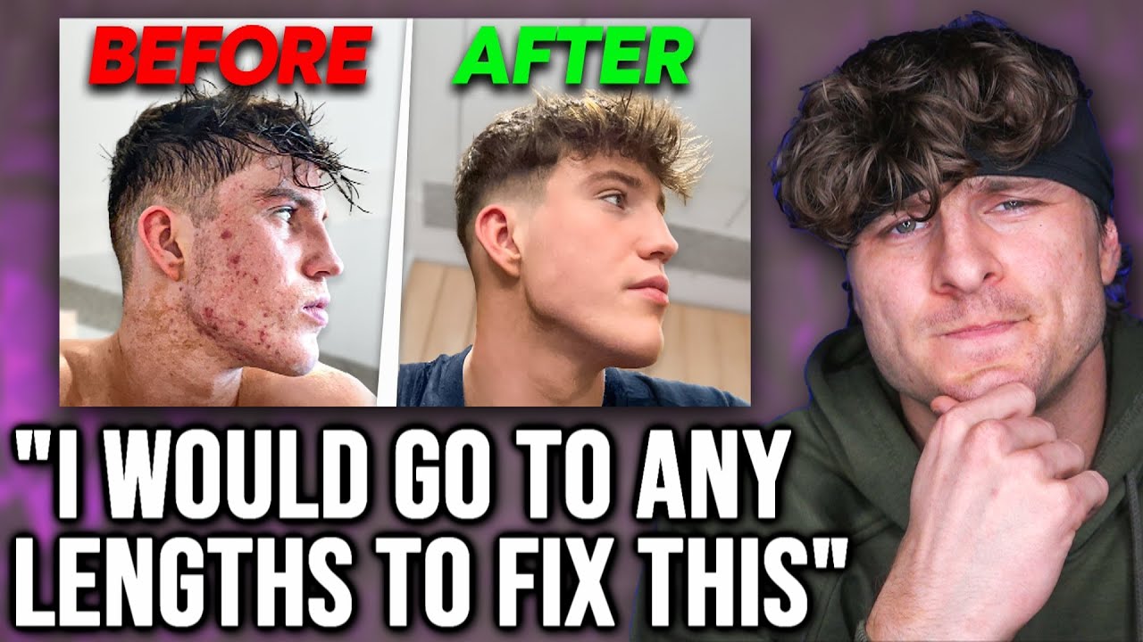 How I Cleared My Acne  (Joe Fazer) | REACTION