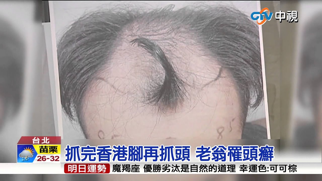 【中視新聞】 抓完香港腳再抓頭 老翁罹頭癬 20150824