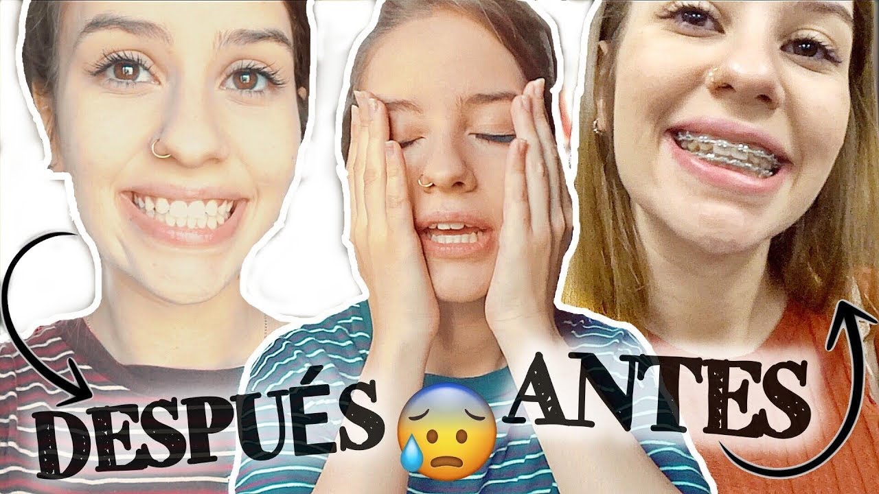 😁 ME QUITAN LOS BRACKETS! No me gustó el resultado? Dolor? AGENESIA DENTAL | Wilo