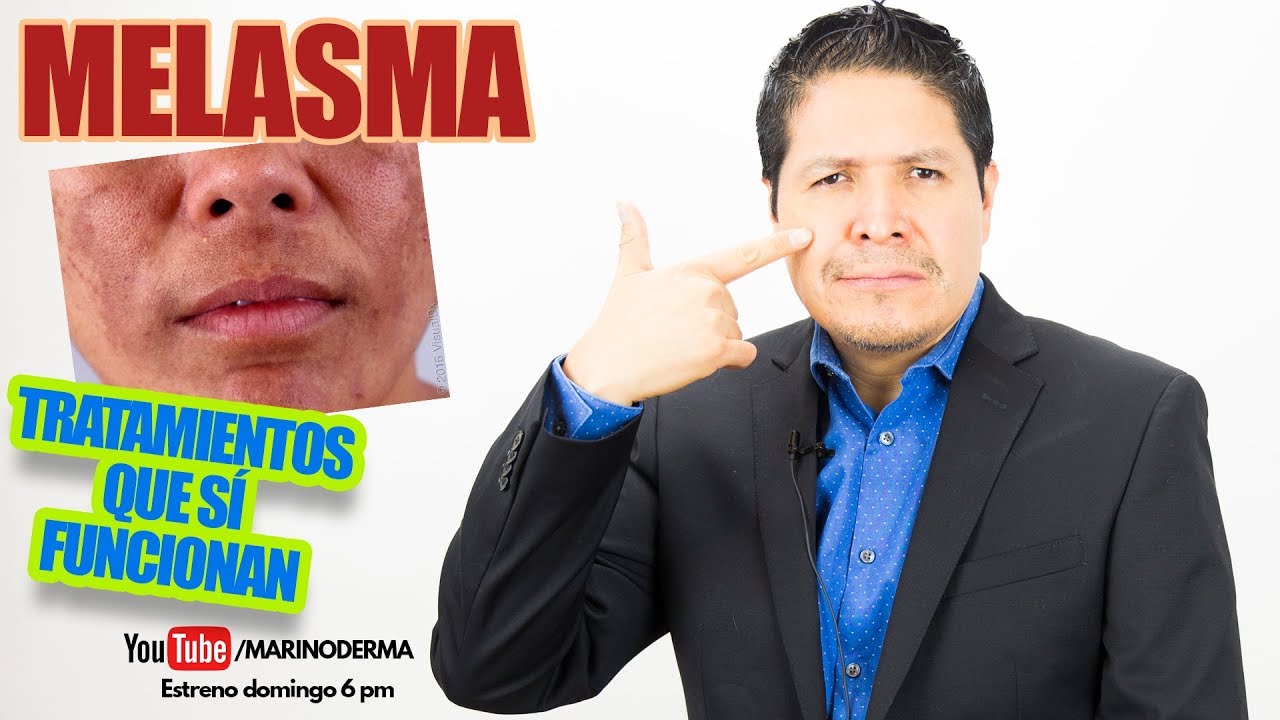 PAÑO MELASMA TRATAMIENTOS QUE SÍ FUNCIONAN DR. MARINO DERMATÓLOGO