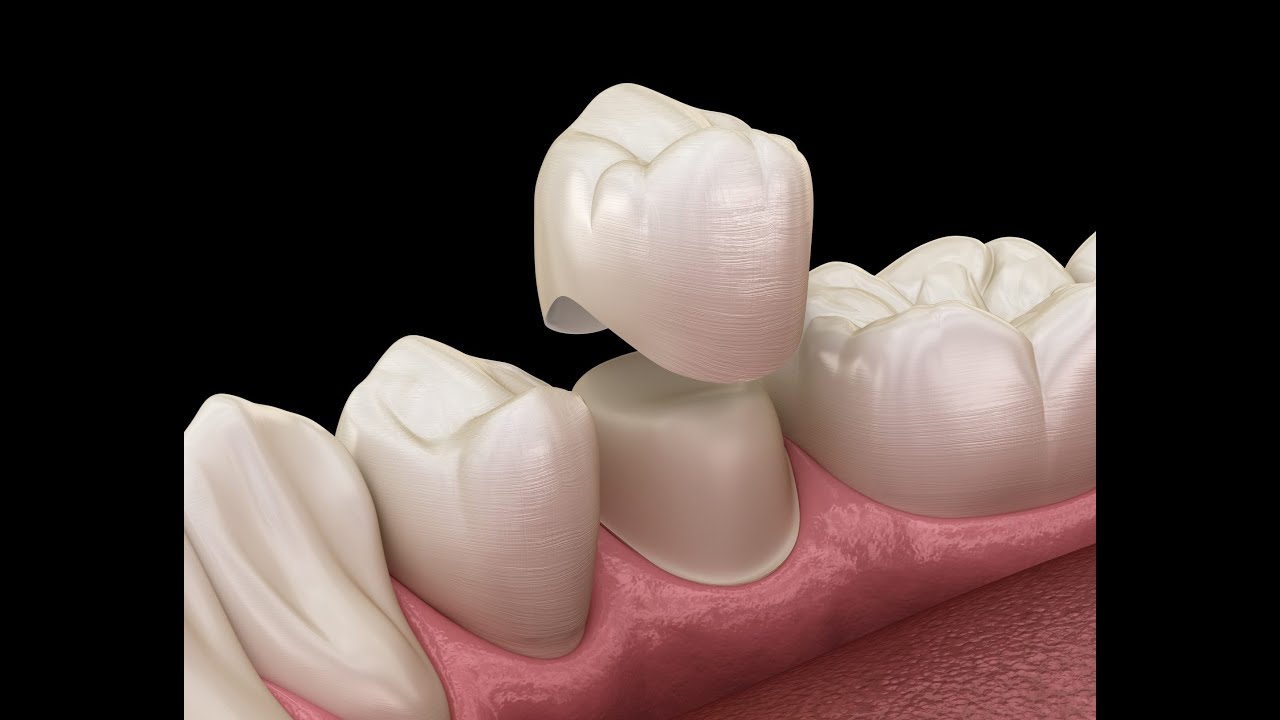 Temporary Dental Crown - How to Prevent Tooth Pain with Perfect Margins