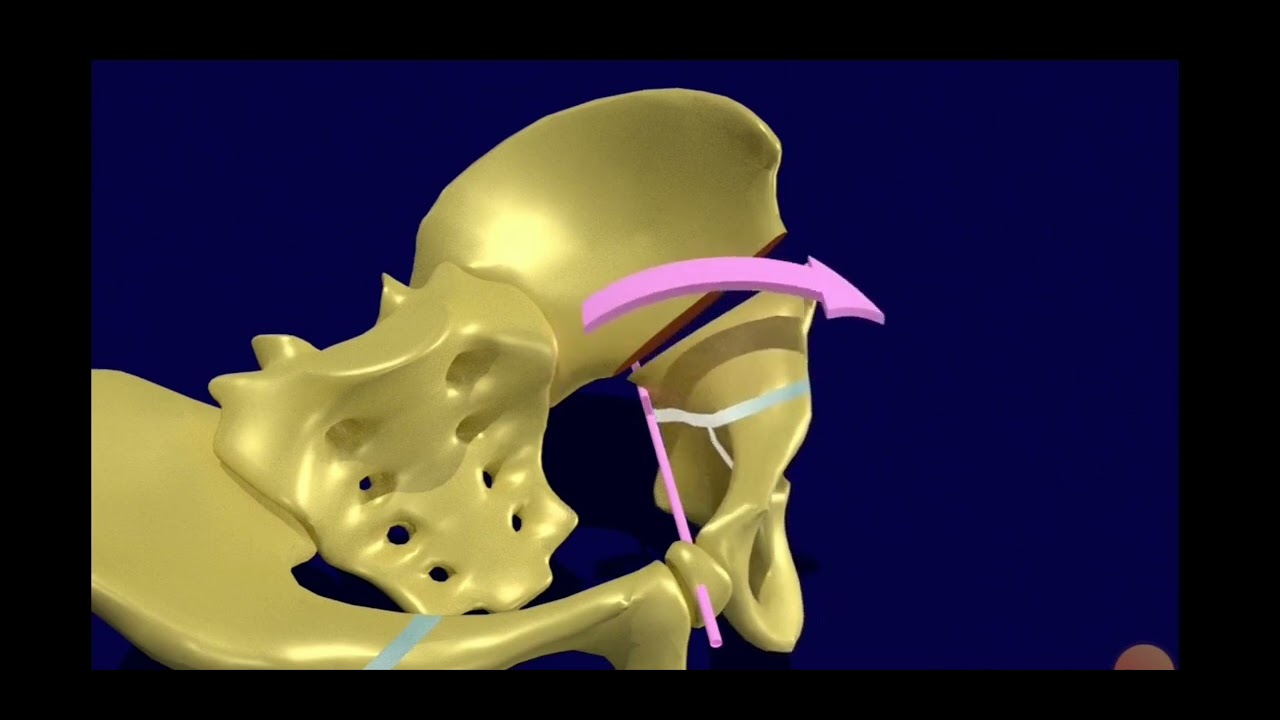 Salter Osteotomy
