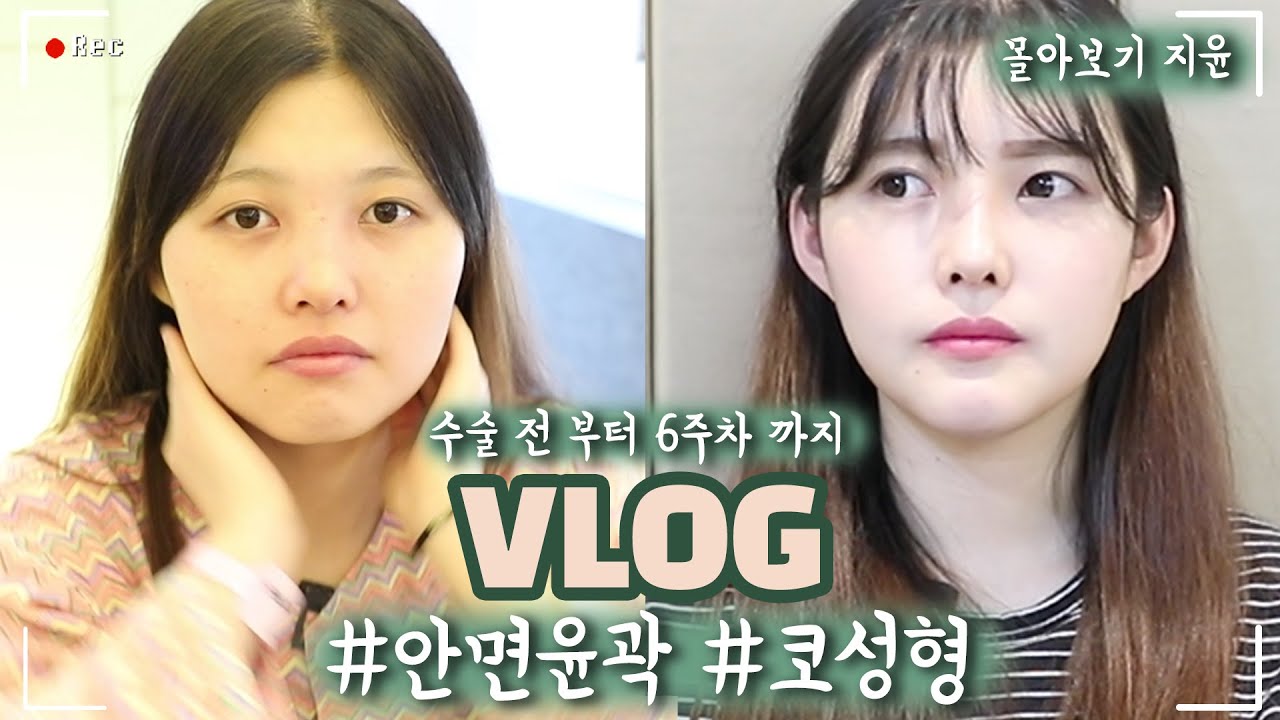 [몰아보기] 안면윤곽 수술 전부터 수술 한 달 차까지 일차별 리얼 vlog 안면윤곽 3종 + 코성형 전후차이 효과 대박😎 [쀼]