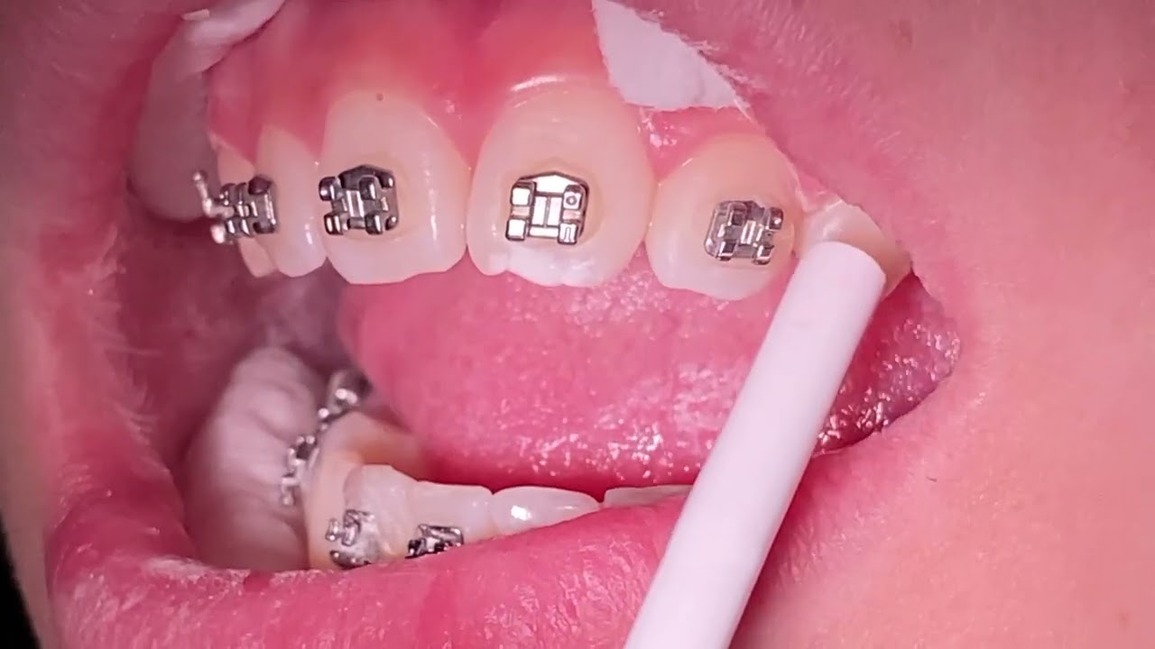 Braces Checkups - Orthodontic Bracket Repositioning - Tooth Time Family Dentistry New Braunfels