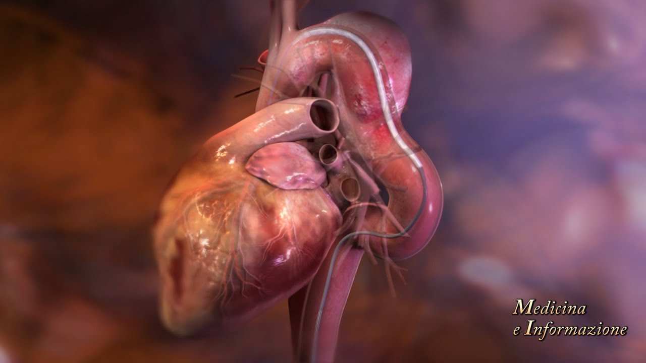 Aneurismi dell'Aorta: endoprotesi customizzata, tecnica percutanea