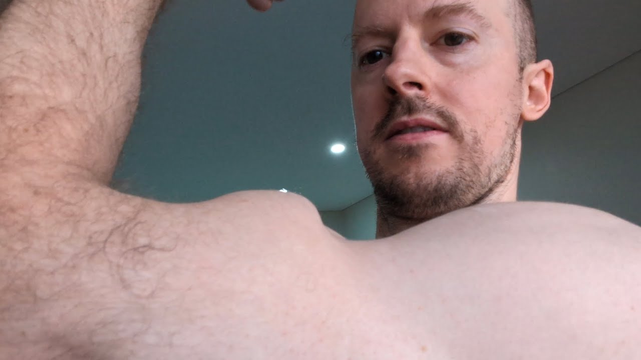 Biceps Tenodesis - Torn long head - 1 day before surgery