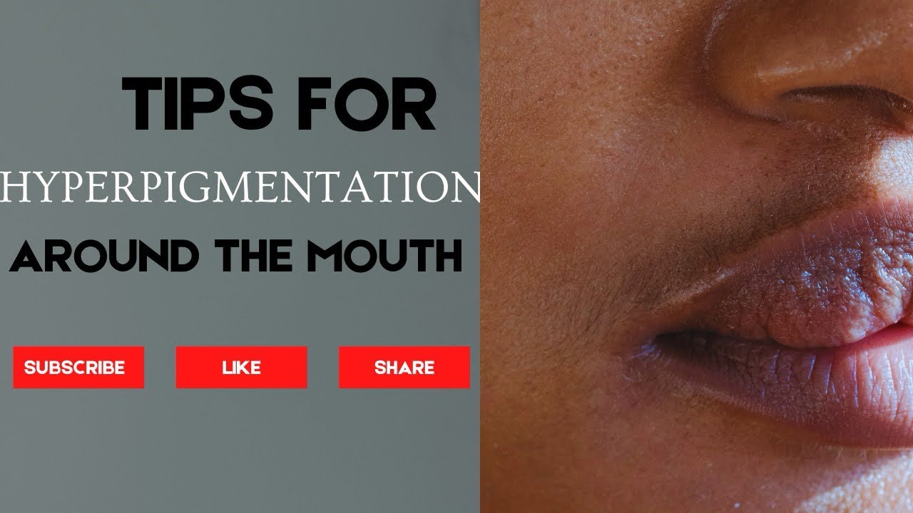 How to treat hyperpigmentation around mouth|| Brown or Black Skin #hyperpigmentation