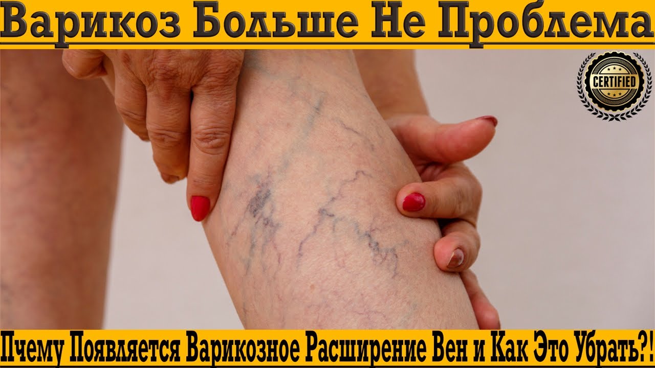 За ноги больше не стыдно! Почему появляется варикоз и как быстро убрать вены?!