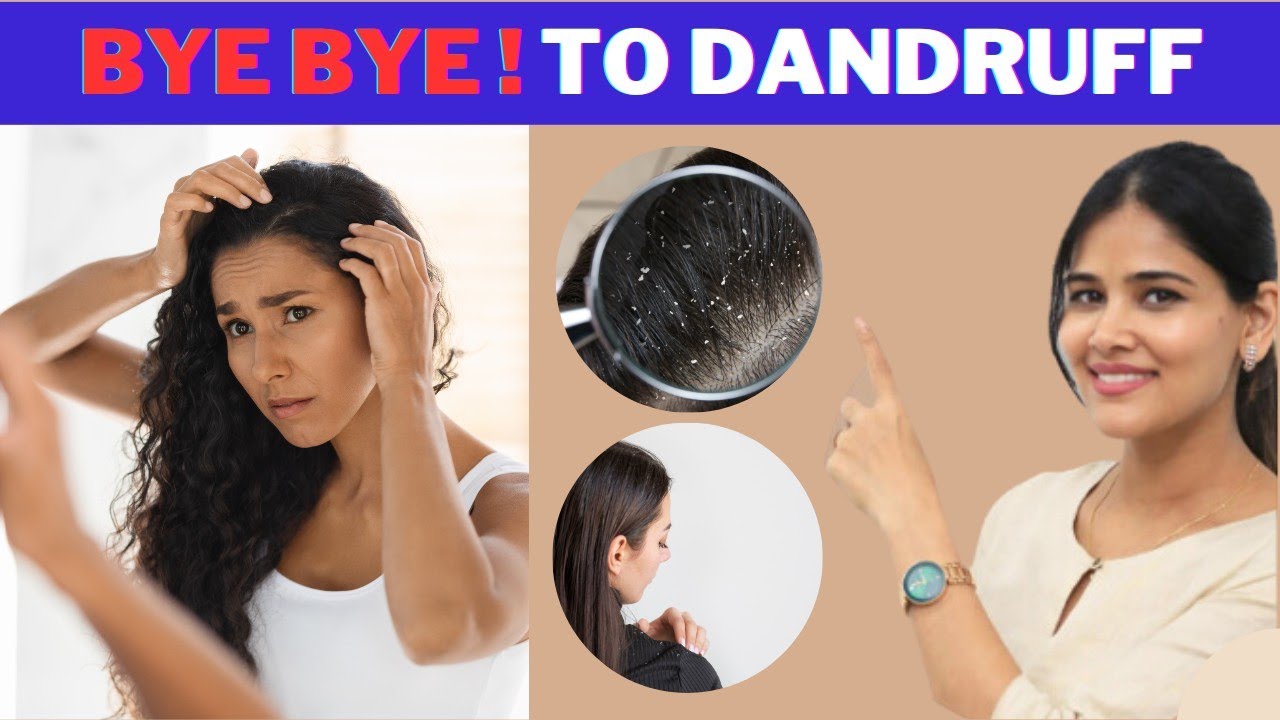 Everything you need to know about dandruff🙆‍♀️ in Telugu || Dr. Priyanka Reddy || DNA Skin Clinic ||