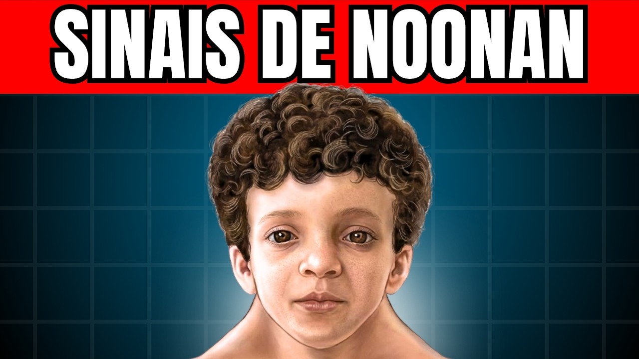 Síndrome de Noonan: Sinais Principais Como Ptose e Baixa Estatura