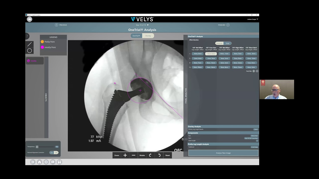 VELYS™ Hip Navigation: The Power of Data-Driven Decisions Using Fluoroscopy