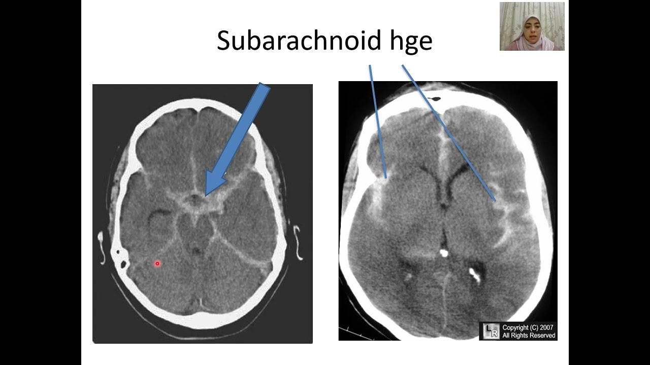 CT brain Part 2 Dr Manar - Pediatric Neurology