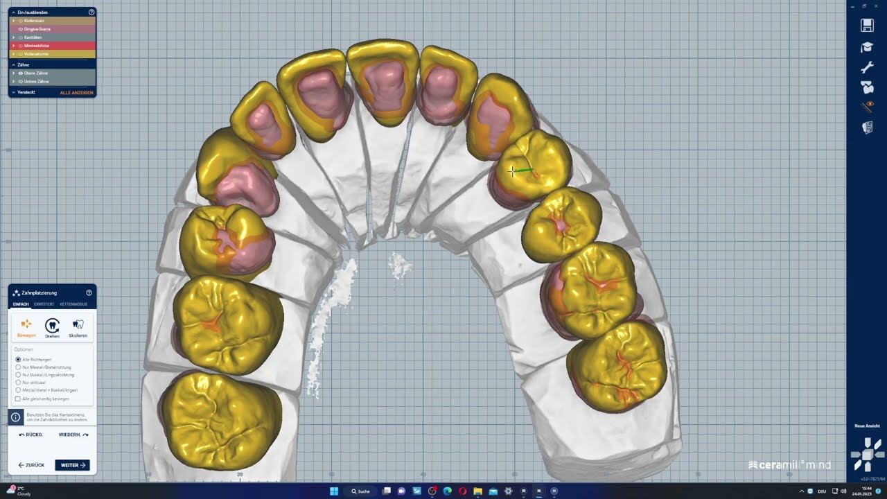 Exocad Tutorial 15 PMMA Provisorium beide Kiefer Schwer!
