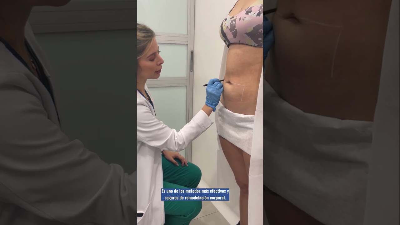 Morpheus 8 para grasa localizada - EsVital Center Salud & Bienestar