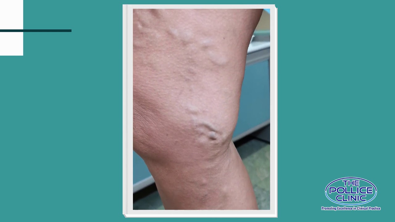 Trattamento delle varici con microscleroterapia e flebectomia