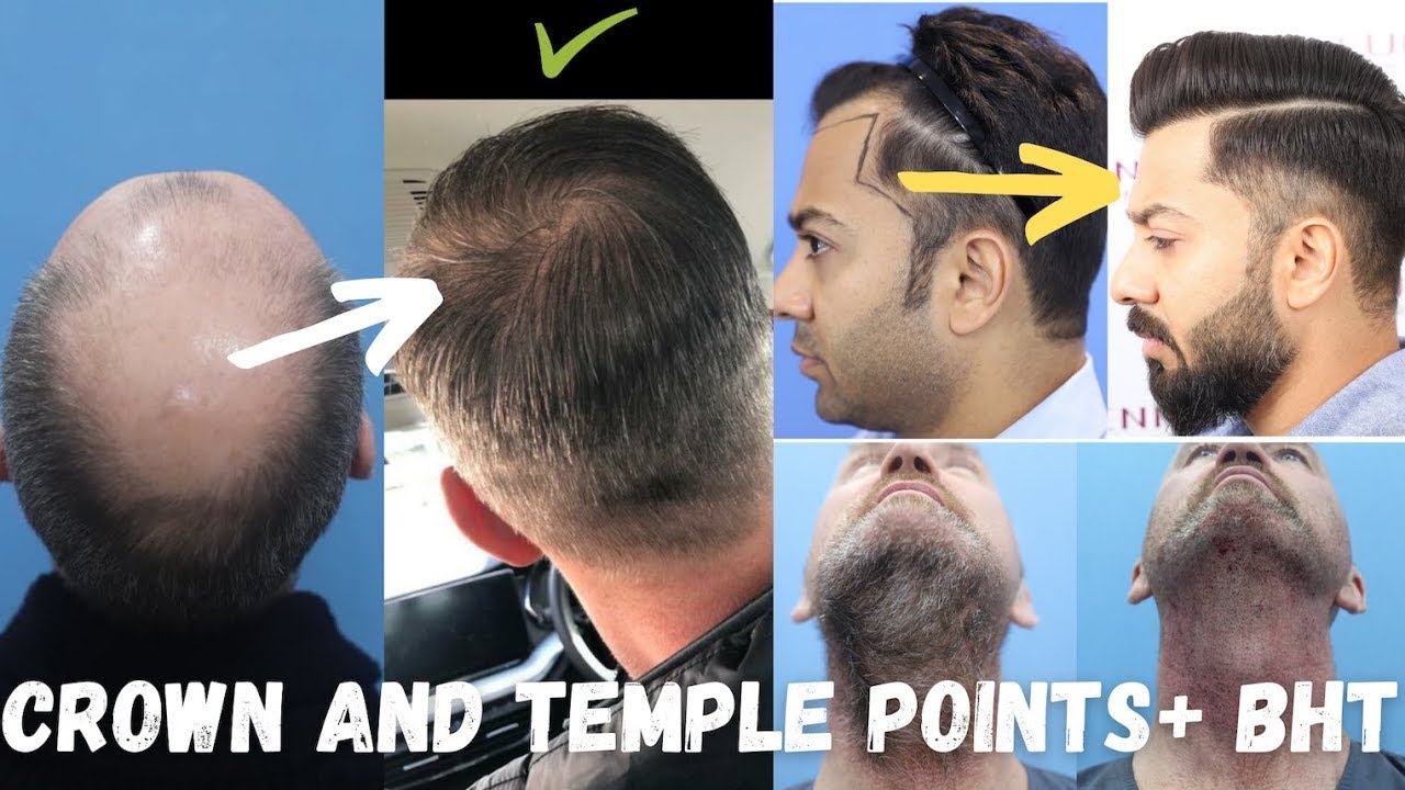 Melvin, Associate Publisher & Forum Moderator @HairTransplantNetwork  for his Hair Transplant