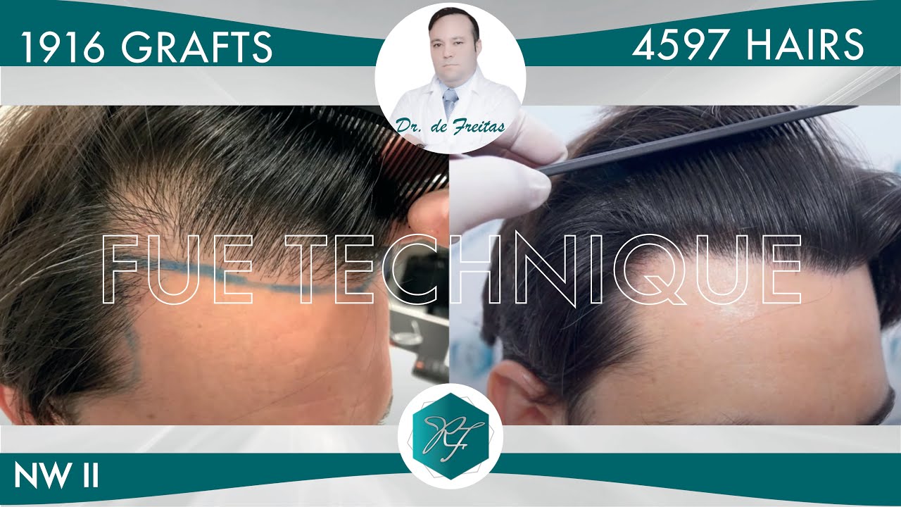 Injerto Capilar Técnica FUE – 1.916 Grafts (4.597 Pelos) – Dr. Rafael de Freitas.