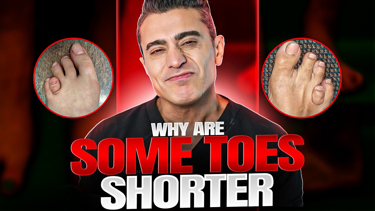 Brachymetatarsia Explained: Diagnosis and Treatment for Short Toes