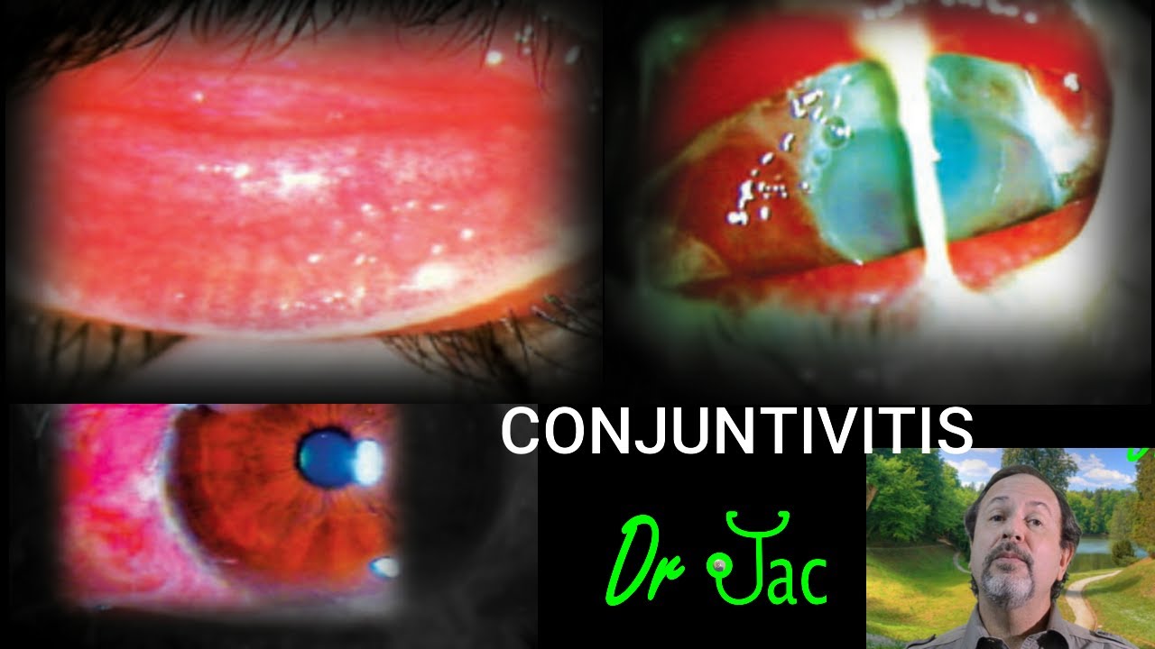 Conjuntivitis