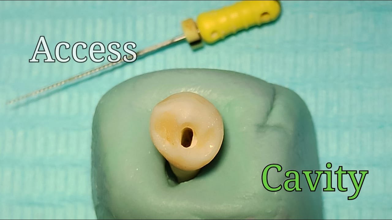 Access Cavity Preparation - Mandibular First Premolar