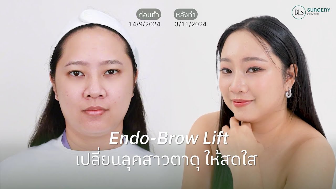 Endo-Brow Lift ส่องกล้องยกคิ้ว เปลี่ยนลุคสาวตาดุ ให้สดใส | ยกคิ้วด้วยวัสดุเอนโดไทน์