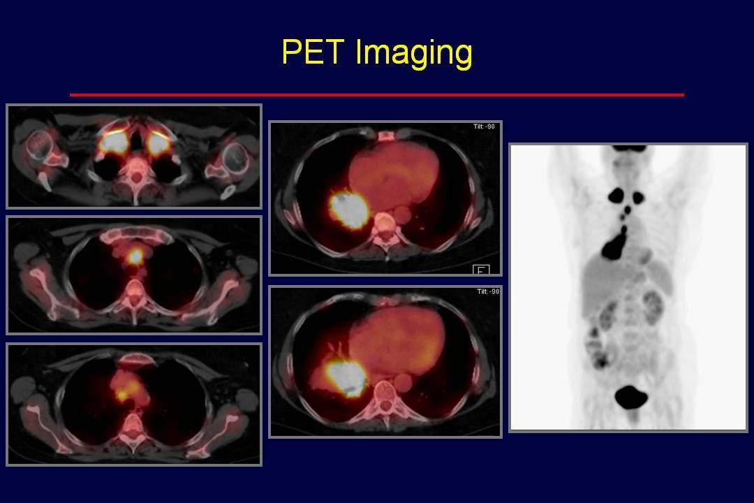 GRACEcast-061_Lung-Cancer_Expert Round Table - Stage IIIB NSCLC Curative Intent Limits