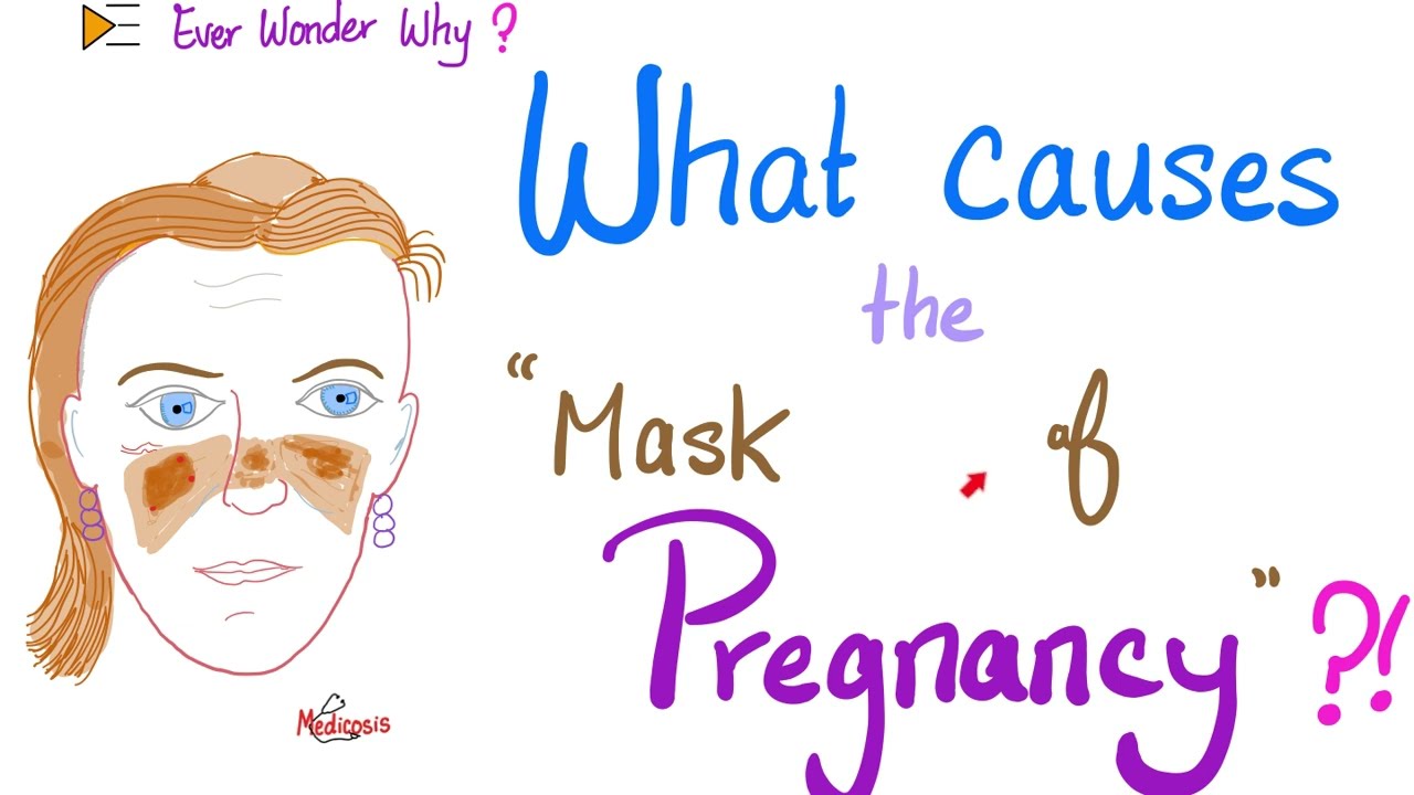 What's the reason behind “The Mask 😷 of Pregnancy 🤰”? 😶‍🌫️😊🤷‍♀️